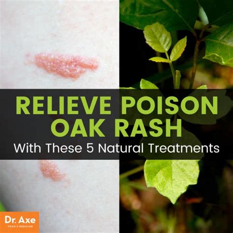 poison oak rash treatments