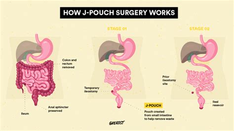 Pouch Surgery