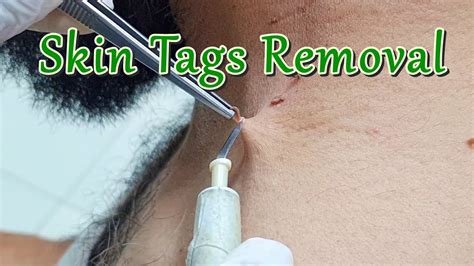 precautions and risks of skin tag removal