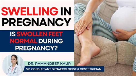 pregnancy swelling