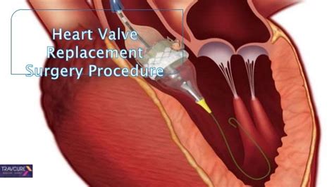 Preparation for Aorta Heart Valve Replacement Surgery