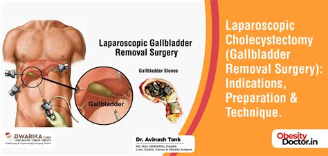 Preparation for Laparoscopic Gallbladder Surgery