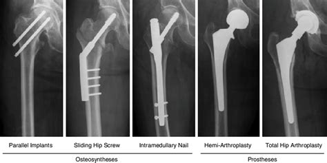 Preparation for Hip Fracture Surgery