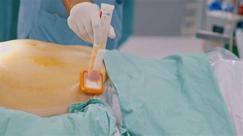 Preparation for Stomach Surgery