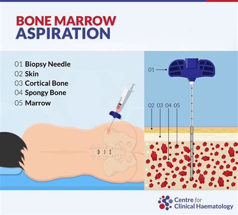 preparing for bone marrow biopsy