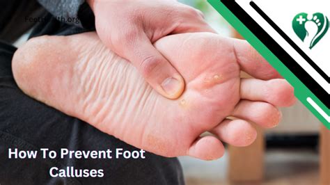 Preventing Callus