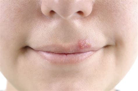 Preventing Cold Sore Outbreaks