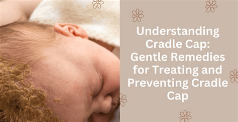 Preventing Cradle Cap