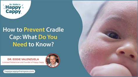 Preventing Cradle Cap