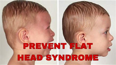 Preventing Flat Head Syndrome