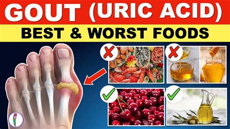 Preventing Gout