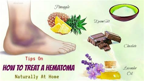 Preventing Hematomas Naturally
