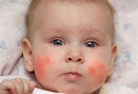 preventing infant face rash