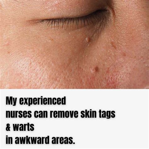 Prevention of skin tags