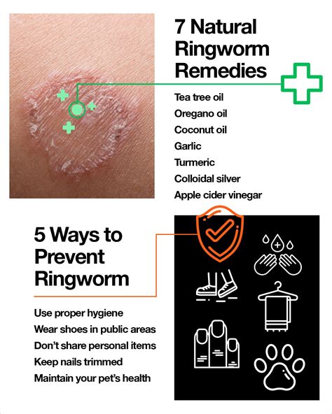 prevention and treatment of ringworm