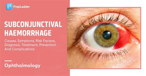 Prevention of Conjunctival Hemorrhage