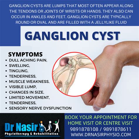 prevention of ganglion cysts