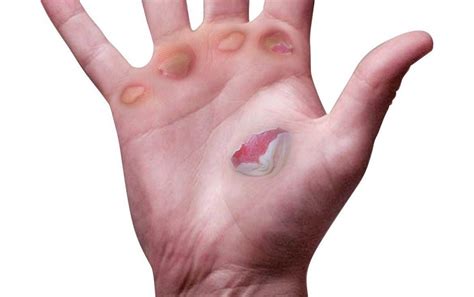 Prevention of blisters on hands