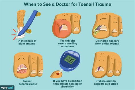Prevention of Injured Toenail Bed