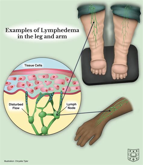 prevention of lymph node pain