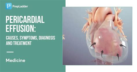 Prevention of Pericardial Effusion