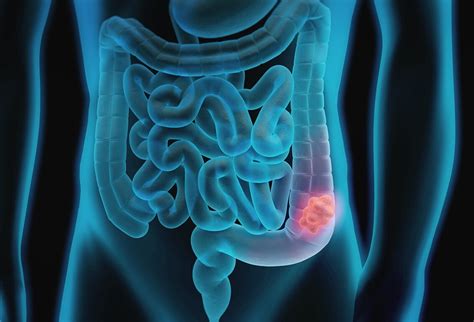 prevention of small intestine blockage