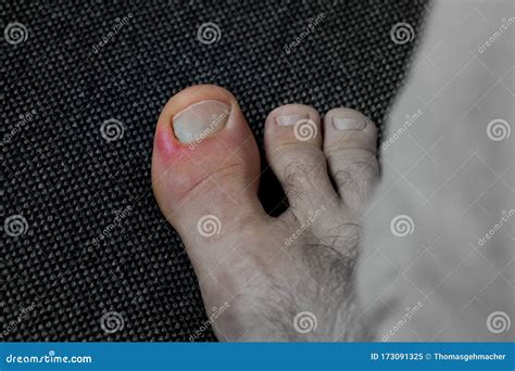 prevention of toe nail bed pain