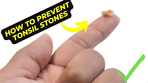 prevention of tonsil stones