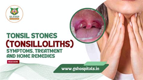 Prevention of tonsilloliths