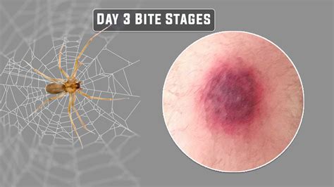Preventive Measures for Brown Recluse Spider Bites