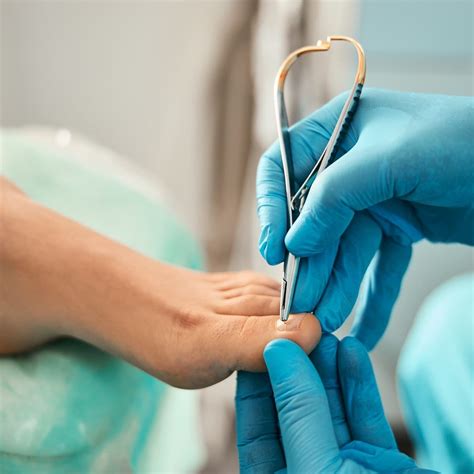 Preventive Measures for Ingrown Nail