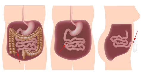 Proctocolectomy with Ileostomy