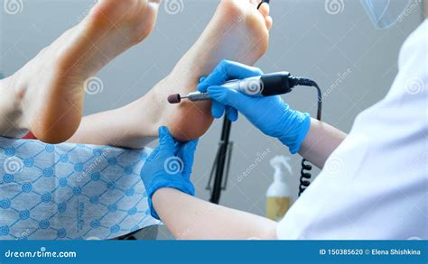 Professional Treatment for Calluses