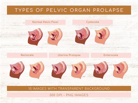 prolapse symptoms