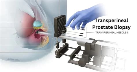 Prostate Biopsy Procedure
