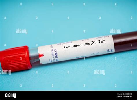 Prothrombin Time Test and Anticoagulant Therapy