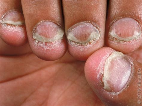 Psoriatic arthritis nail signs