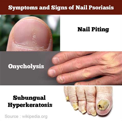 Psoriatic Nail Disease Symptoms
