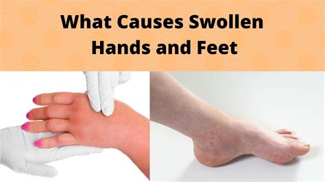 puffy hands and feet