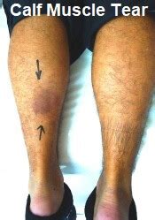 pulled calf muscle symptoms