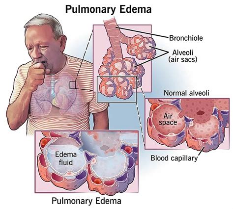 Pulmonary Edema