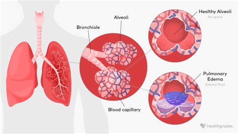 Pulmonary Edema Treatment