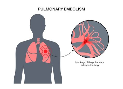 Pulmonary Embolism