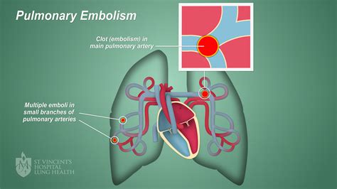 pulmonary embolism causes
