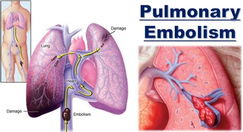 pulmonary embolism living
