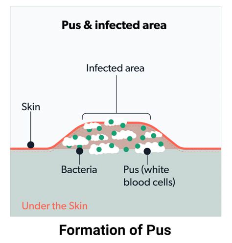 pus formation