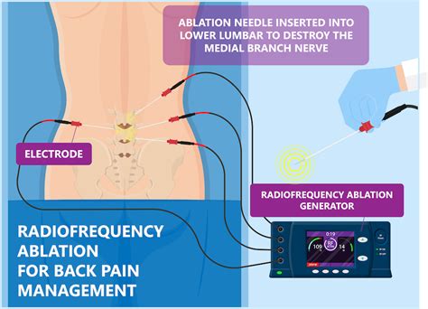 Radiofrequency Ablation
