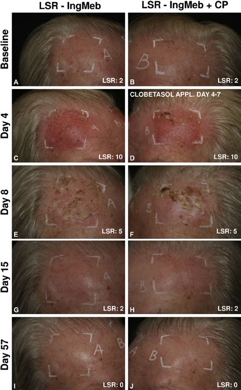 rare but serious side effects of clobetasol propionate
