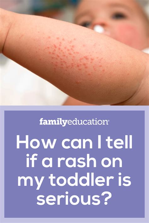 rash on toddler symptoms