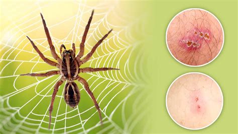 recluse spider bite